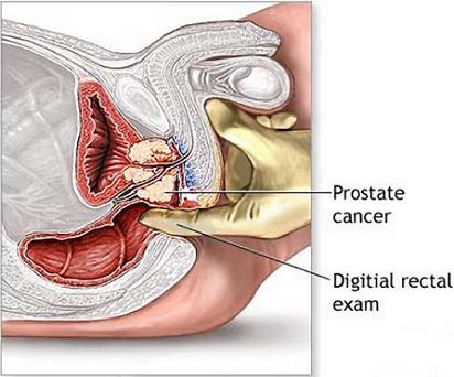 Лечение рака предстательной железы 4 степени в израиле thumbnail
